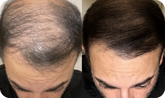 Kiierr Laser Cap customer Reviews