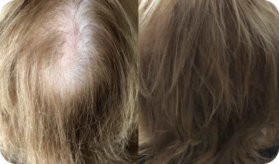 Kiierr Laser Cap official Reviews